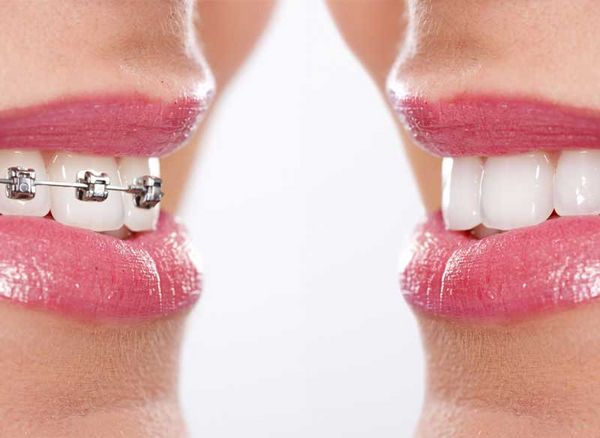 Zahnarztpraxis Dr. Pischel Linz - Vorher-Nacher-Vergleich festsitzende Zahnspange