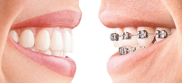 klassischen festsitzenden Zahnspange und unsichtbare Zahnspange